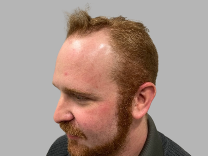 Hair Restoration Before & After Patient #2098