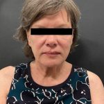 Facelift Before & After Patient #2121