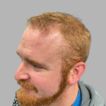 Hair Restoration Before & After Patient #2098