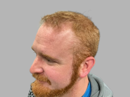 Hair Restoration Before & After Patient #2098