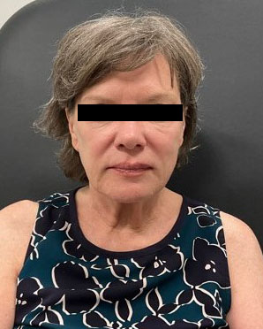 Facelift Before & After Patient #2121