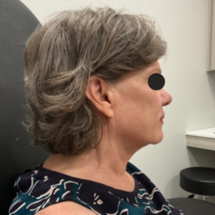 Facelift Before & After Patient #2121