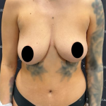 Breast Augmentation + Lift Before & After Patient #2099