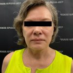 Facelift Before & After Patient #2121