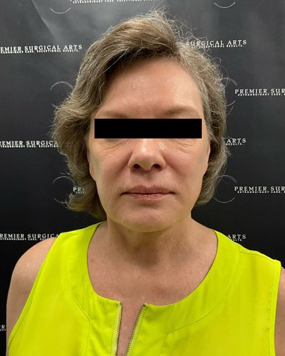 Facelift Before & After Patient #2121