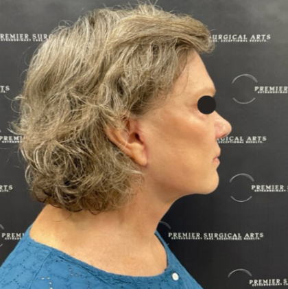 Facelift Before & After Patient #2121