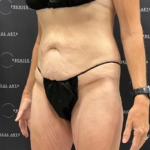 Tummy Tuck Before & After Patient #2101