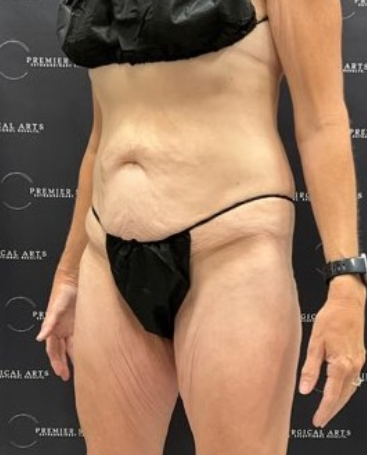 Tummy Tuck Before & After Patient #2101