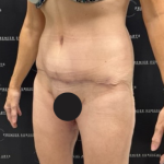 Tummy Tuck Before & After Patient #2101