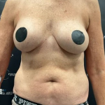 Liposuction Before & After Patient #2102