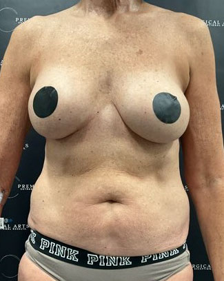 Liposuction Before & After Patient #2102