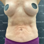 Liposuction Before & After Patient #2102