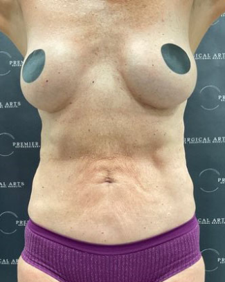 Liposuction Before & After Patient #2102