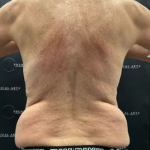 Liposuction Before & After Patient #2102