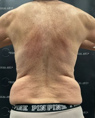 Liposuction Before & After Patient #2102