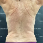 Liposuction Before & After Patient #2102