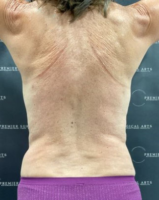 Liposuction Before & After Patient #2102