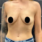 Breast Augmentation + Lift Before & After Patient #2104