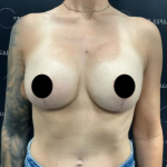 Breast Augmentation + Lift Before & After Patient #2104