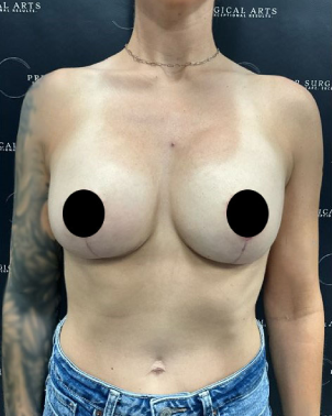 Breast Augmentation + Lift Before & After Patient #2104