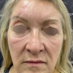 Facelift Before & After Patient #2151