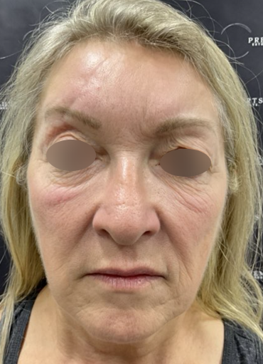 Facelift Before & After Patient #2151