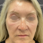Facelift Before & After Patient #2151