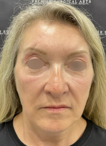 Facelift Before & After Patient #2151