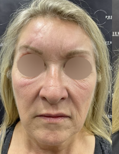Facelift Before & After Patient #2151