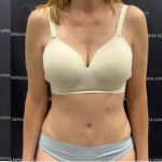 Tummy Tuck Before & After Patient #2158