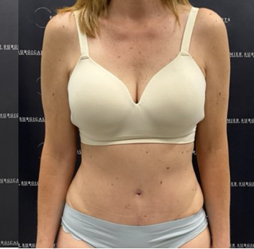 Tummy Tuck Before & After Patient #2158