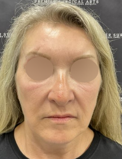 Facelift Before & After Patient #2151
