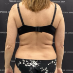Tummy Tuck Before & After Patient #2158