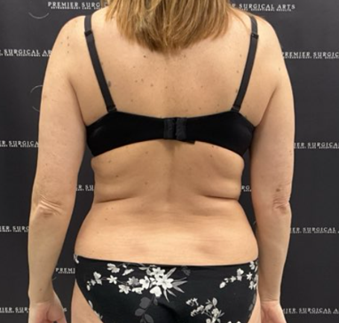 Tummy Tuck Before & After Patient #2158