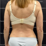 Tummy Tuck Before & After Patient #2158