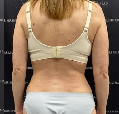 Tummy Tuck Before & After Patient #2158