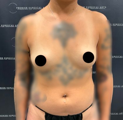 Breast Augmentation Before & After Patient #2231
