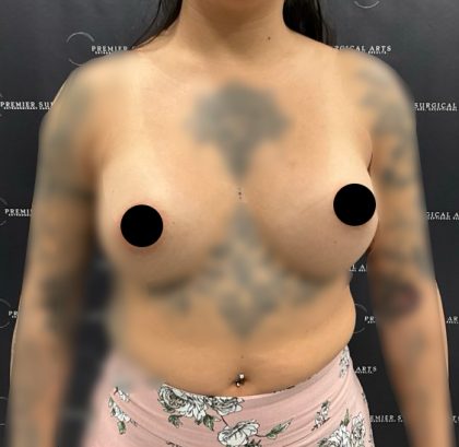 Breast Augmentation Before & After Patient #2231