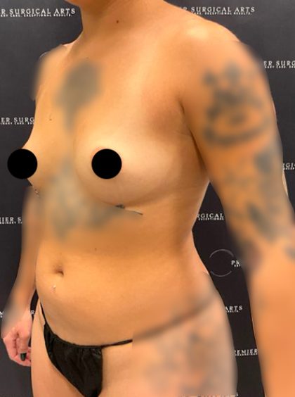 Breast Augmentation Before & After Patient #2231