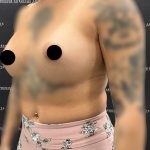 Breast Augmentation Before & After Patient #2231