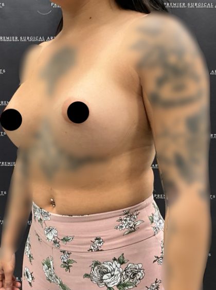 Breast Augmentation Before & After Patient #2231