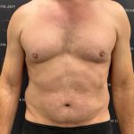 Liposuction Before & After Patient #2181