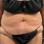 Tummy Tuck Before & After Patient #2193