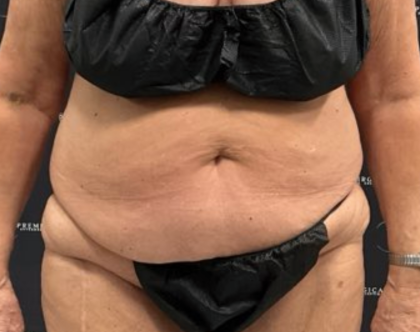 Tummy Tuck Before & After Patient #2193
