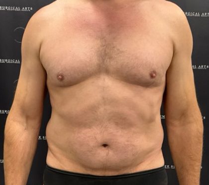 Liposuction Before & After Patient #2181