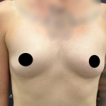 Breast Augmentation Before & After Patient #2163