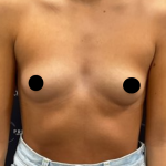 Breast Augmentation Before & After Patient #2198