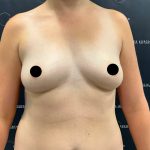 Breast Augmentation Before & After Patient #2203