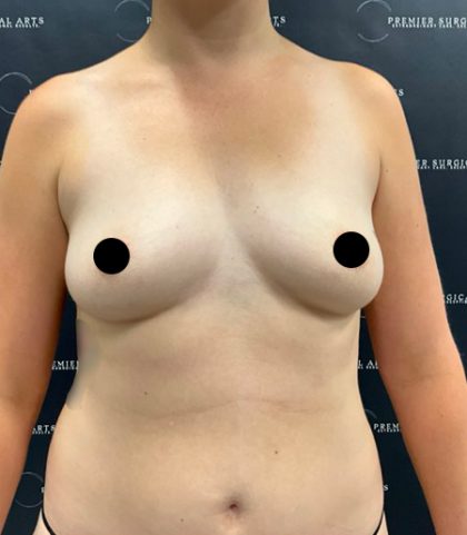 Breast Augmentation Before & After Patient #2203