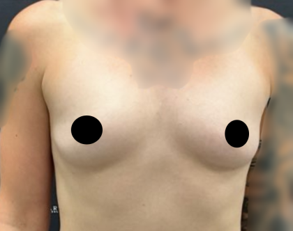 Breast Augmentation Before & After Patient #2163